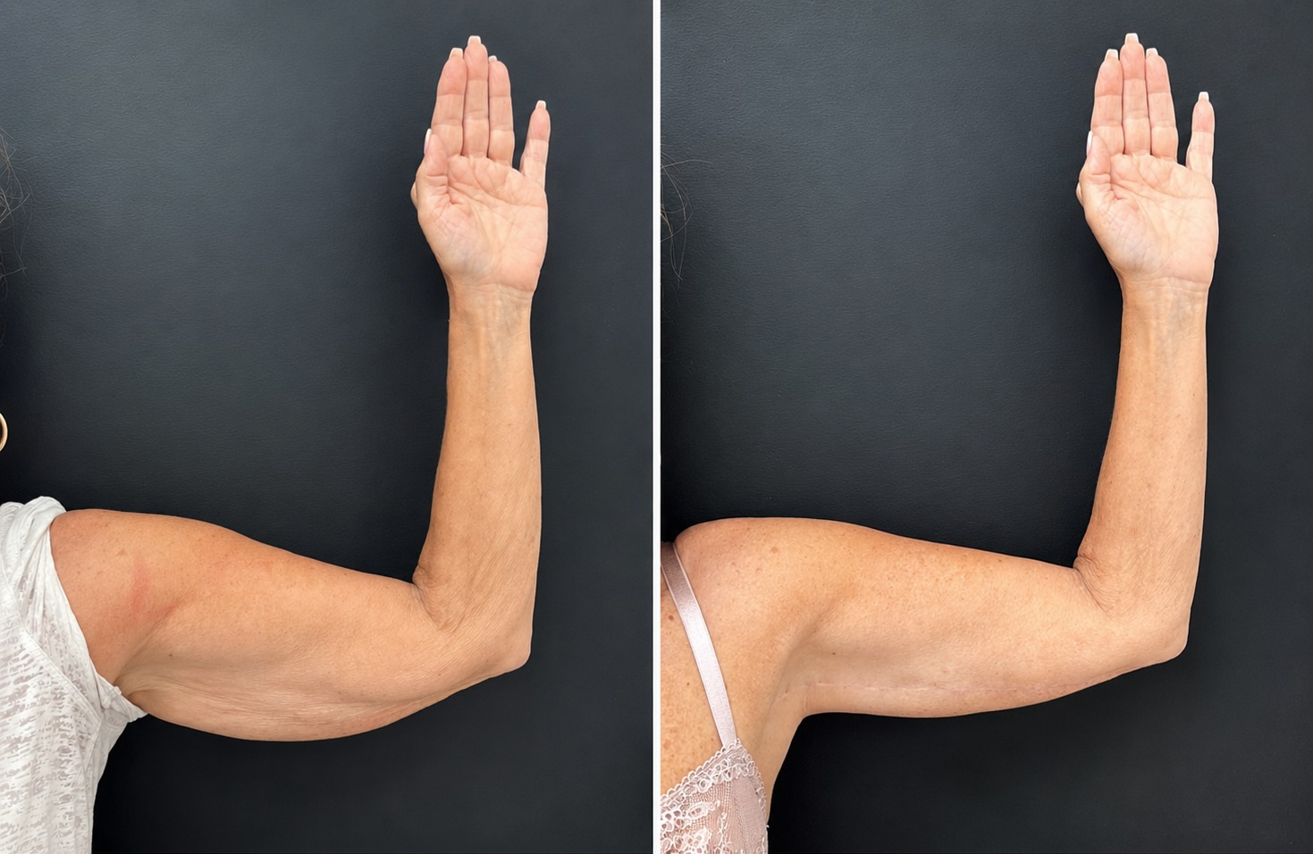 Arm Lift (Brachioplasty) before and after
