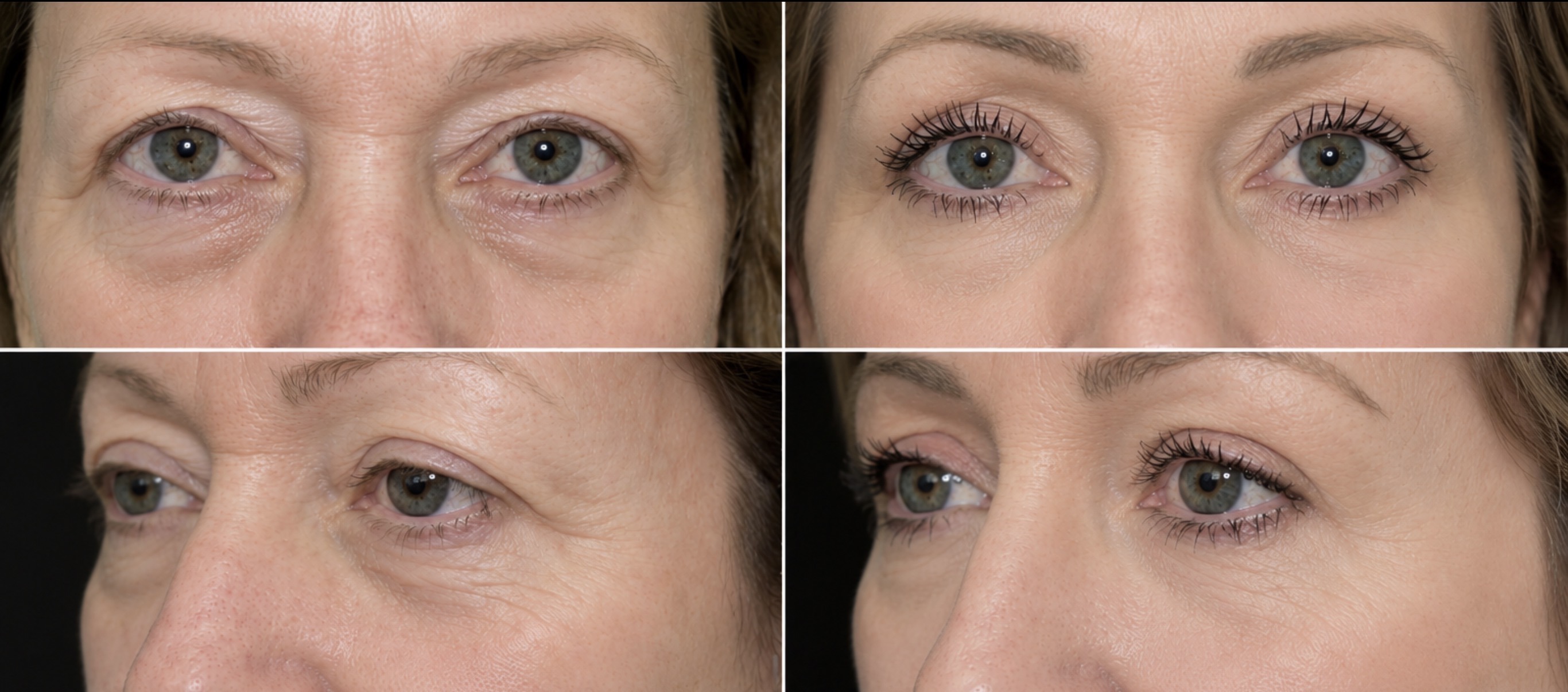 Blepharoplasty (Eyelid Surgery) before and after