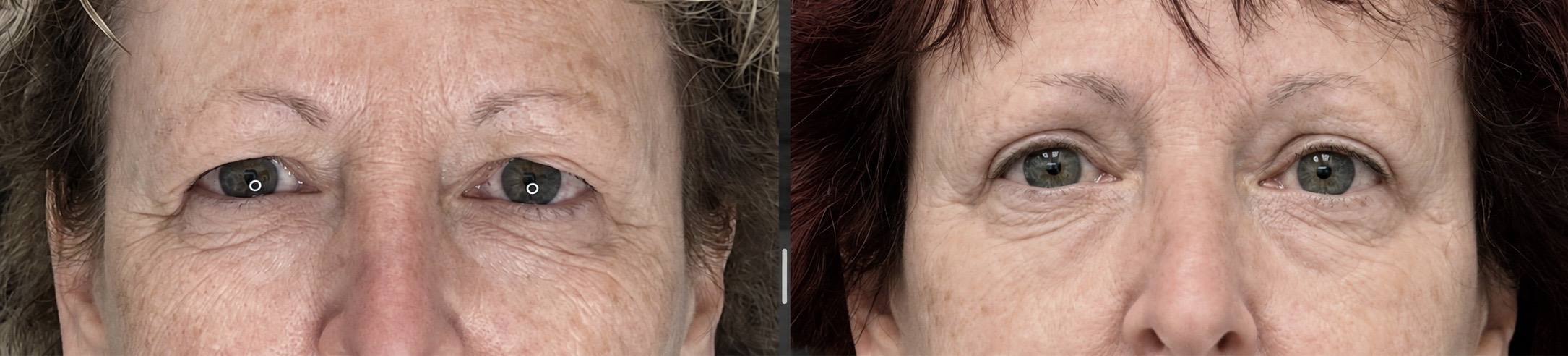 Upper eyelid surgery before and after, Essbé Beauté, Westmount