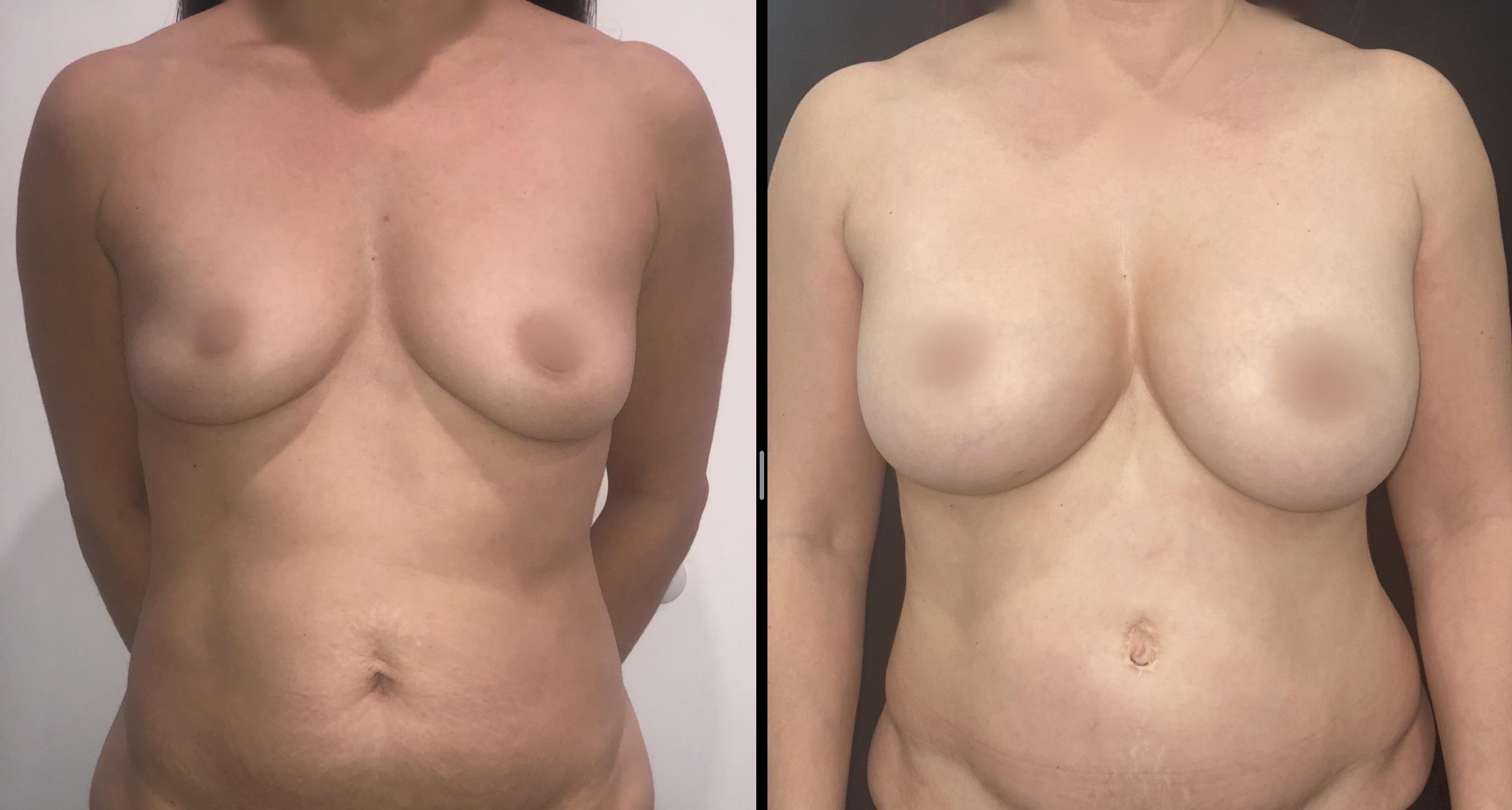 Breast Augmentation before and after