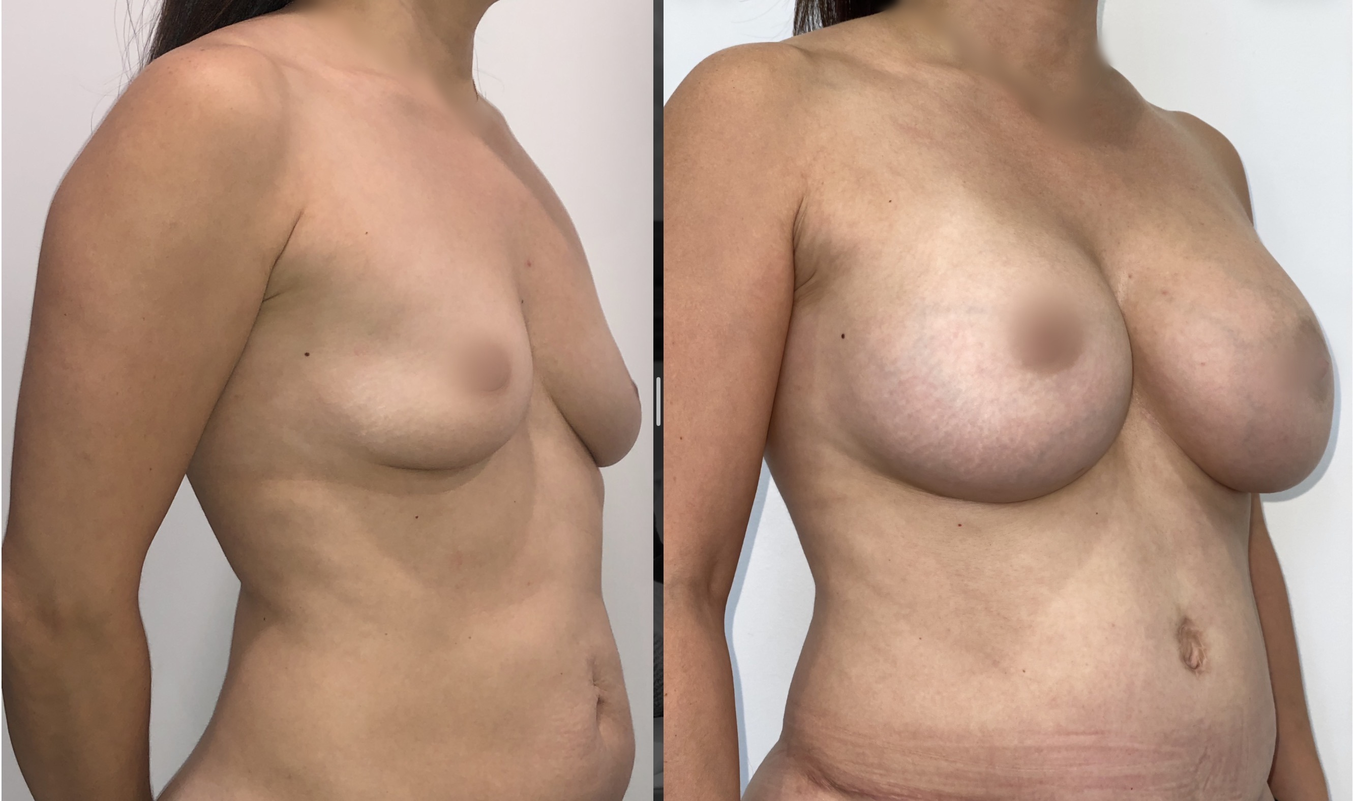 Breast Augmentation before and after