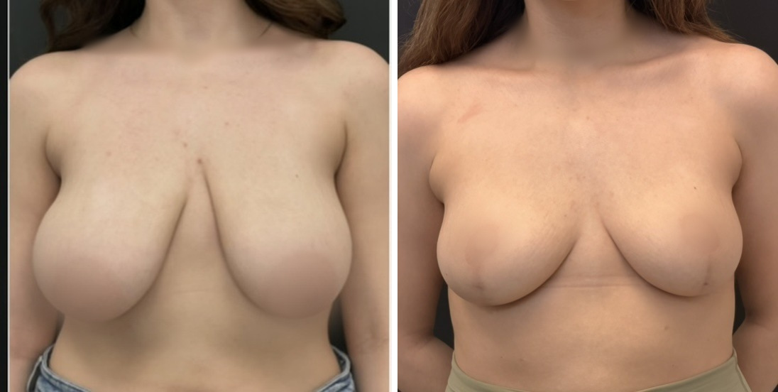 Breast Lift before and after