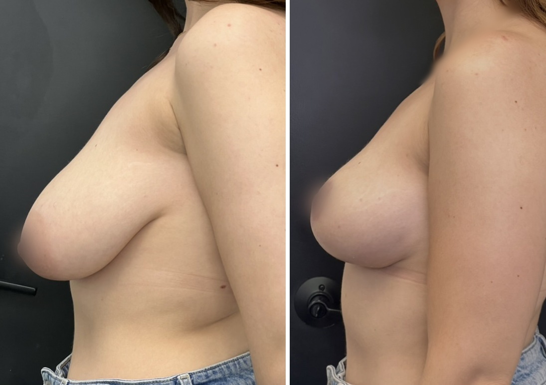 Breast Lift before and after