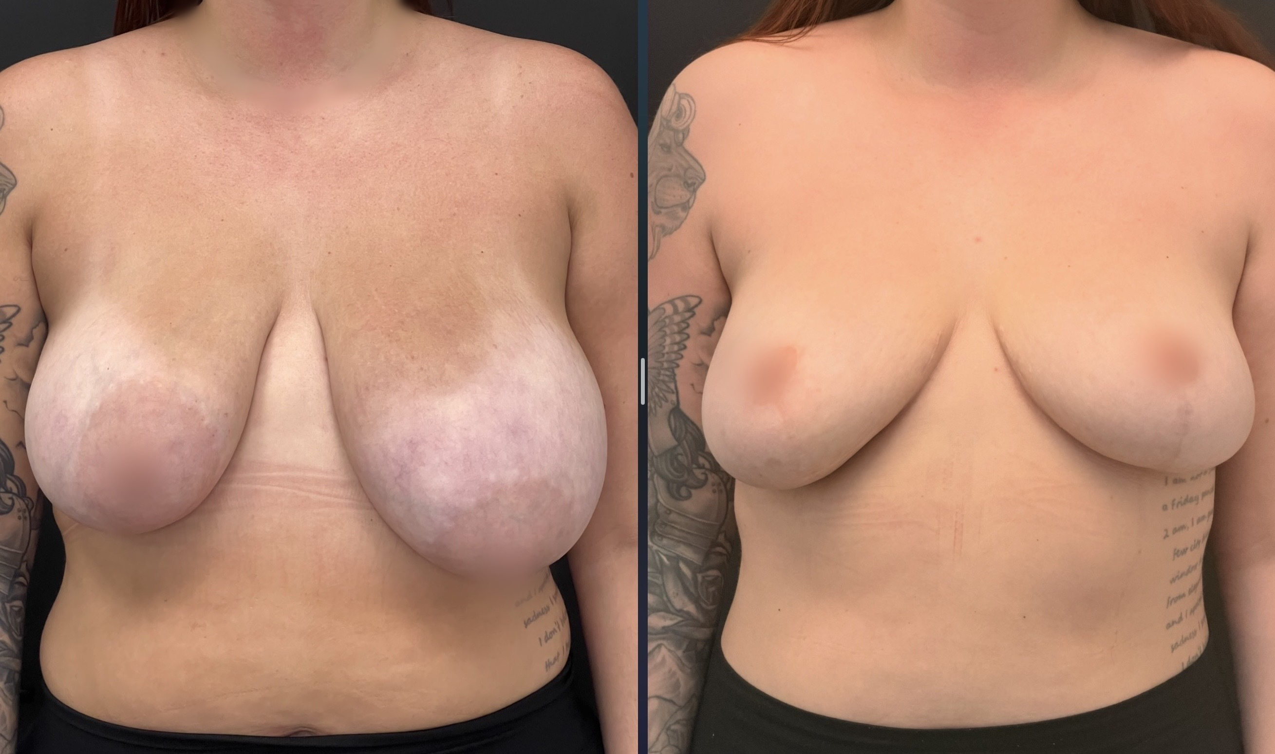 Breast Reduction before and after