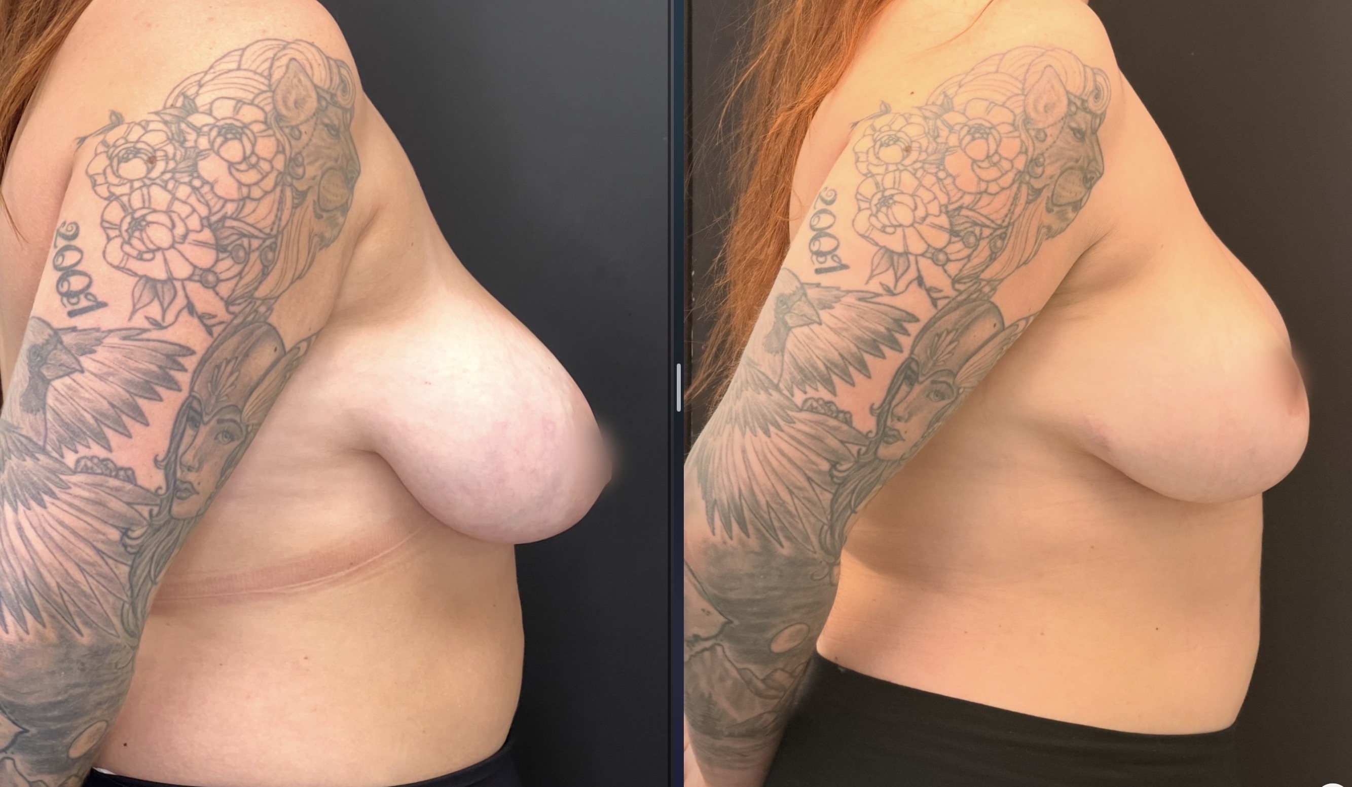 Breast Reduction before and after