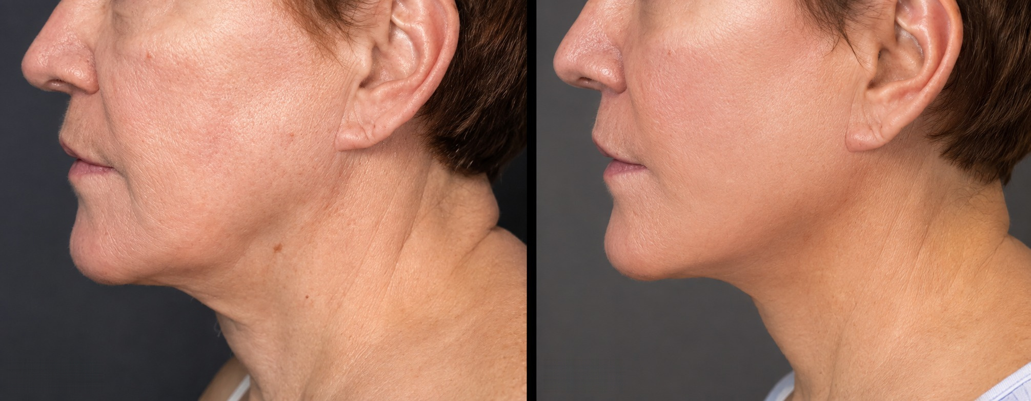 Facelift before and after