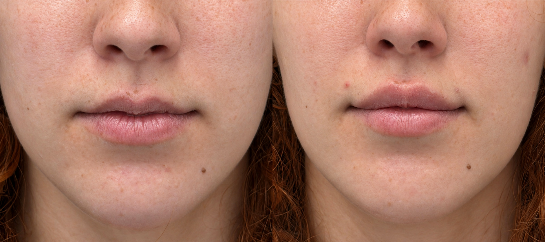 Lip enhancement before and after, front view