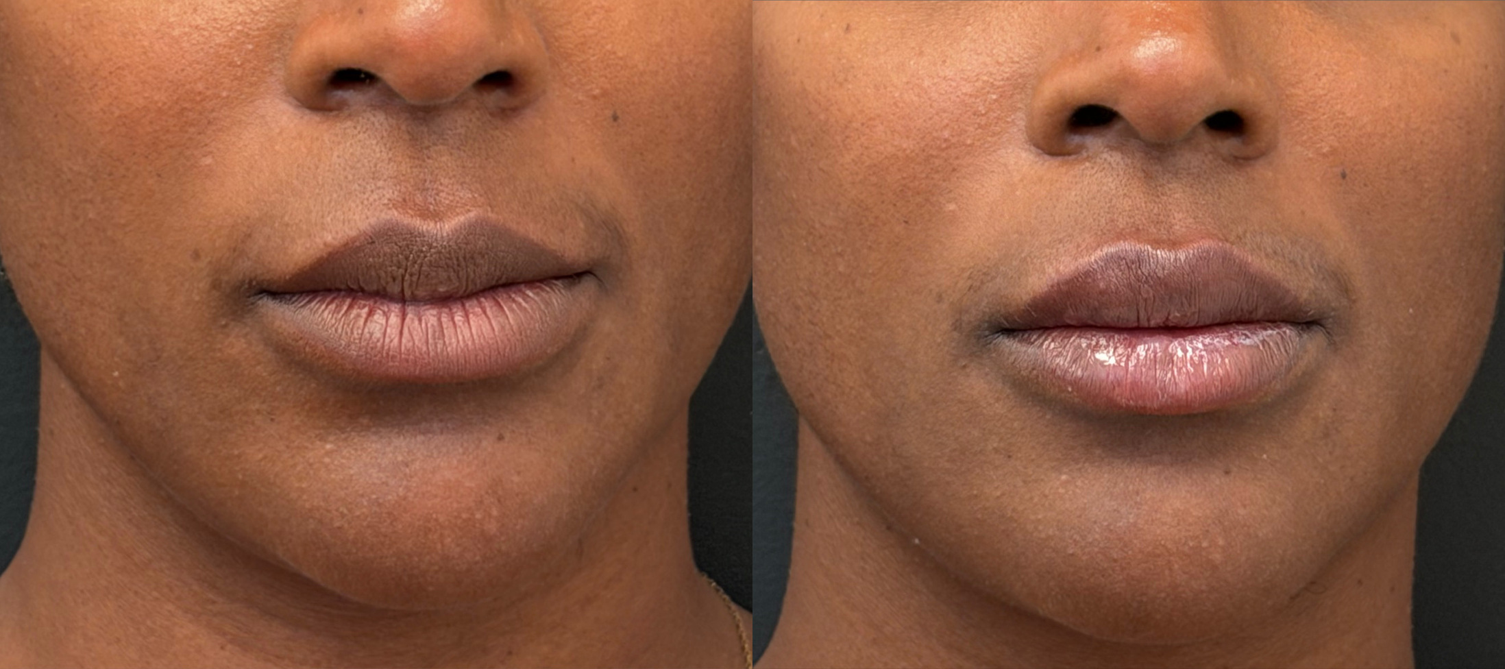 Lip enhancement before and after, front view