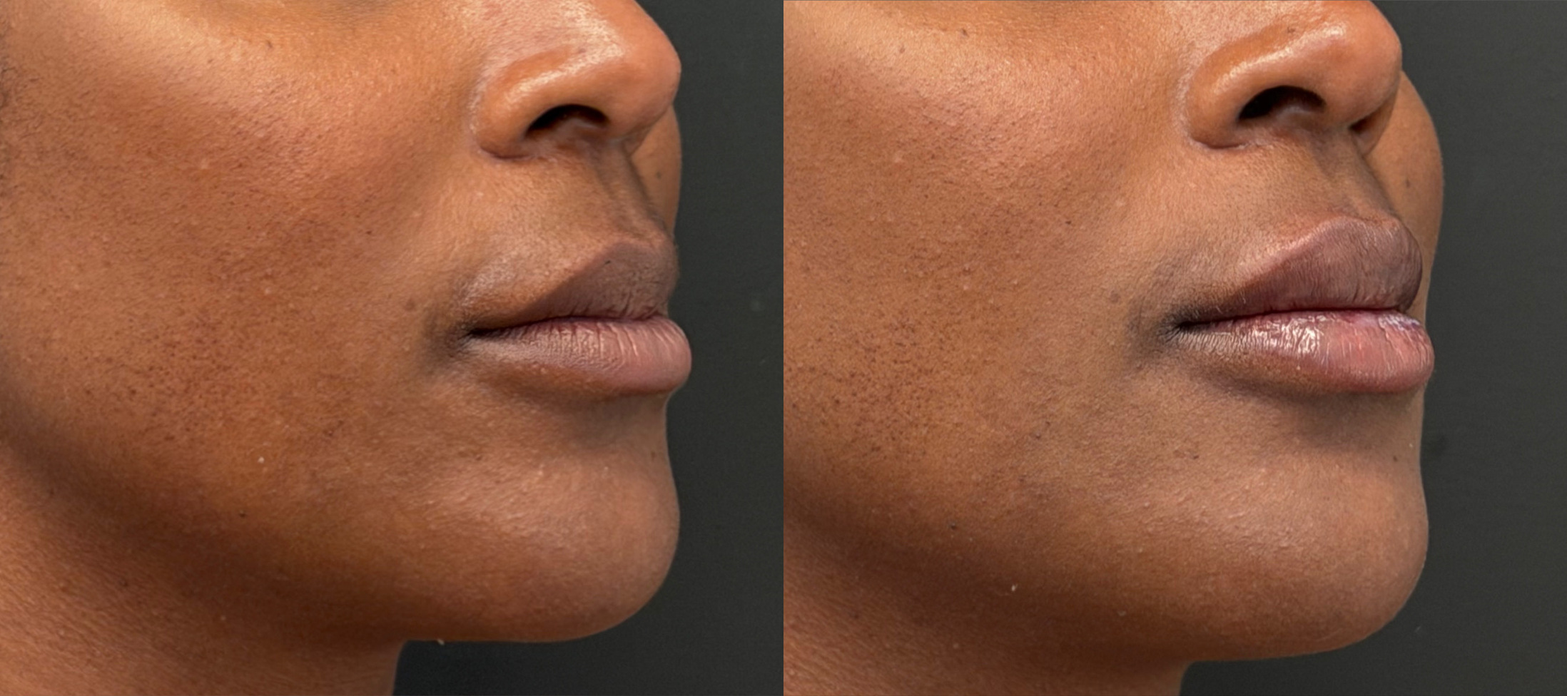 Lip enhancement before and after, three-quarter view
