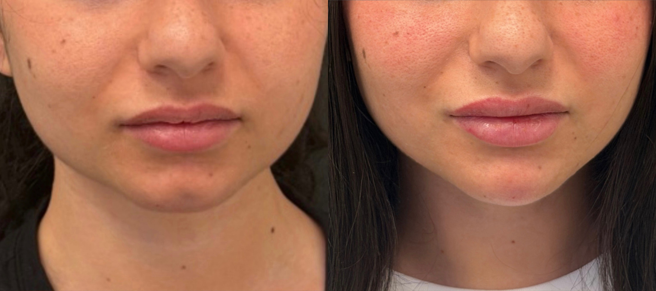 Lip enhancement before and after, front view