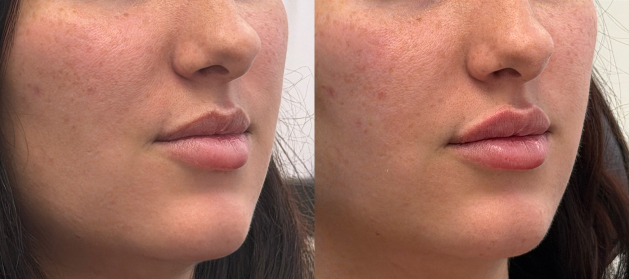 Lip enhancement before and after, three-quarter view