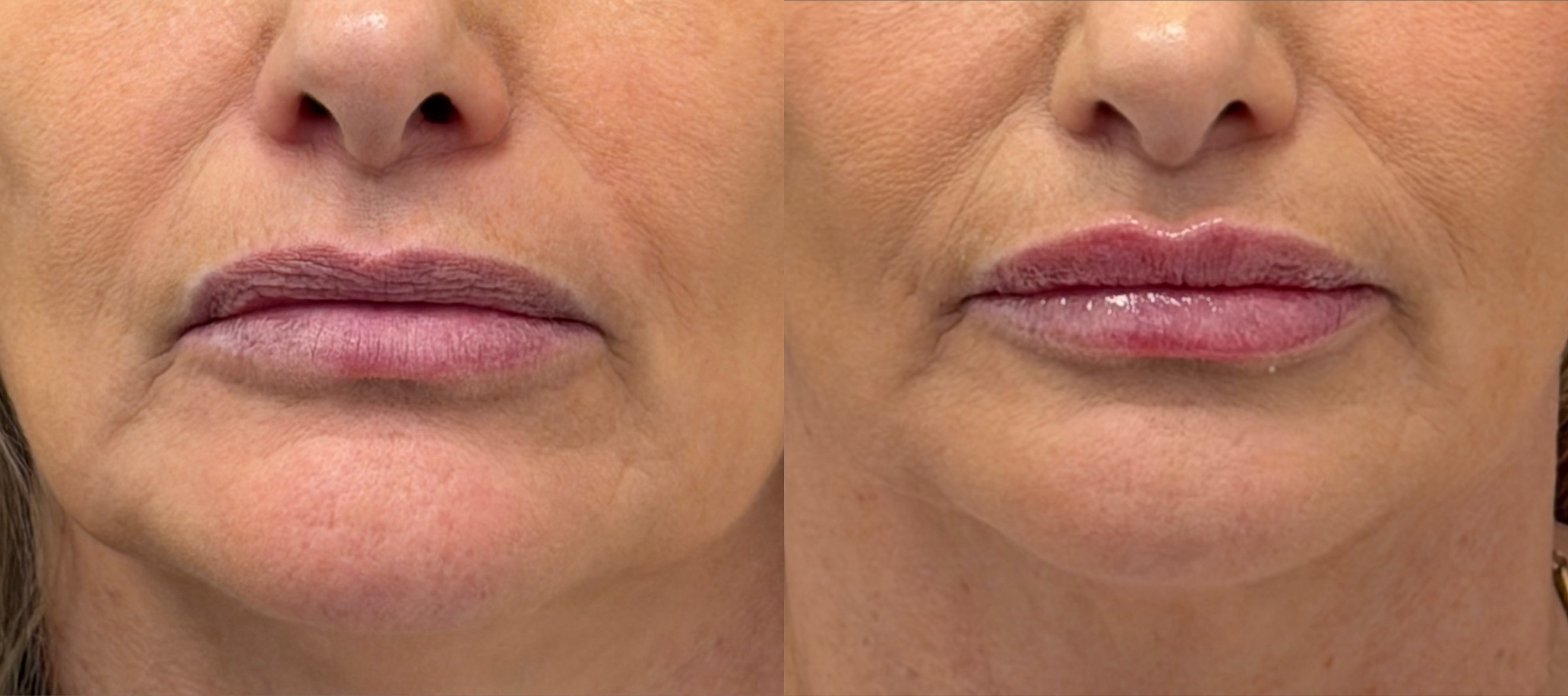 Lip enhancement before and after, front view