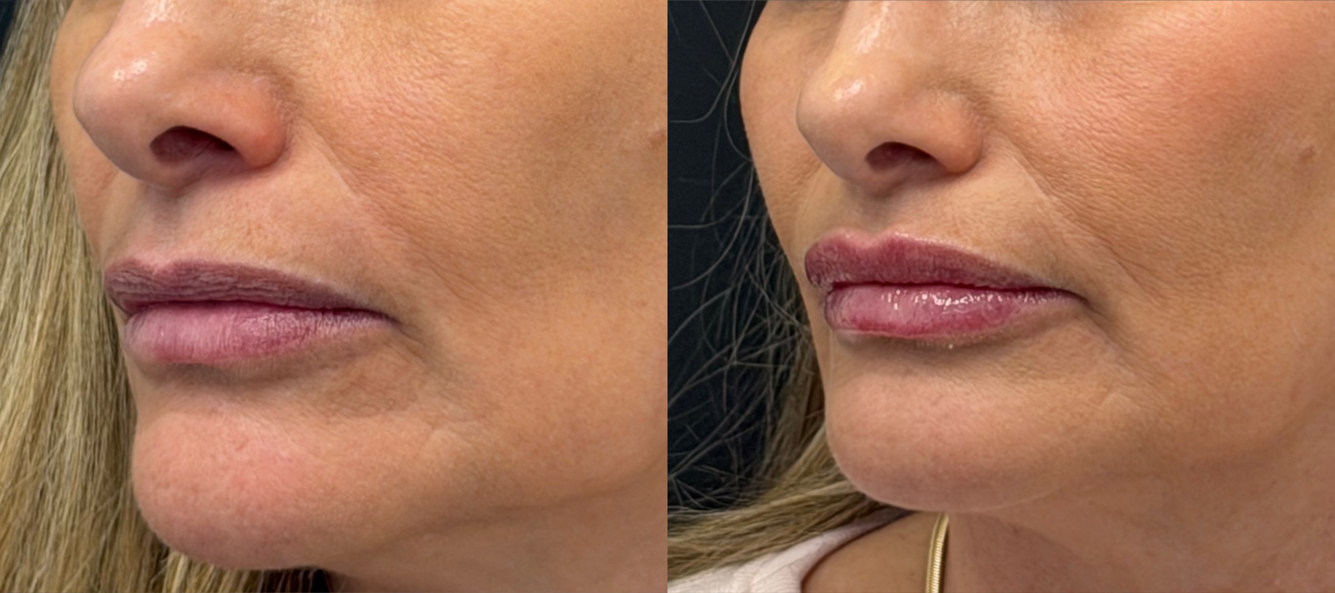 Lip enhancement before and after, three-quarter view
