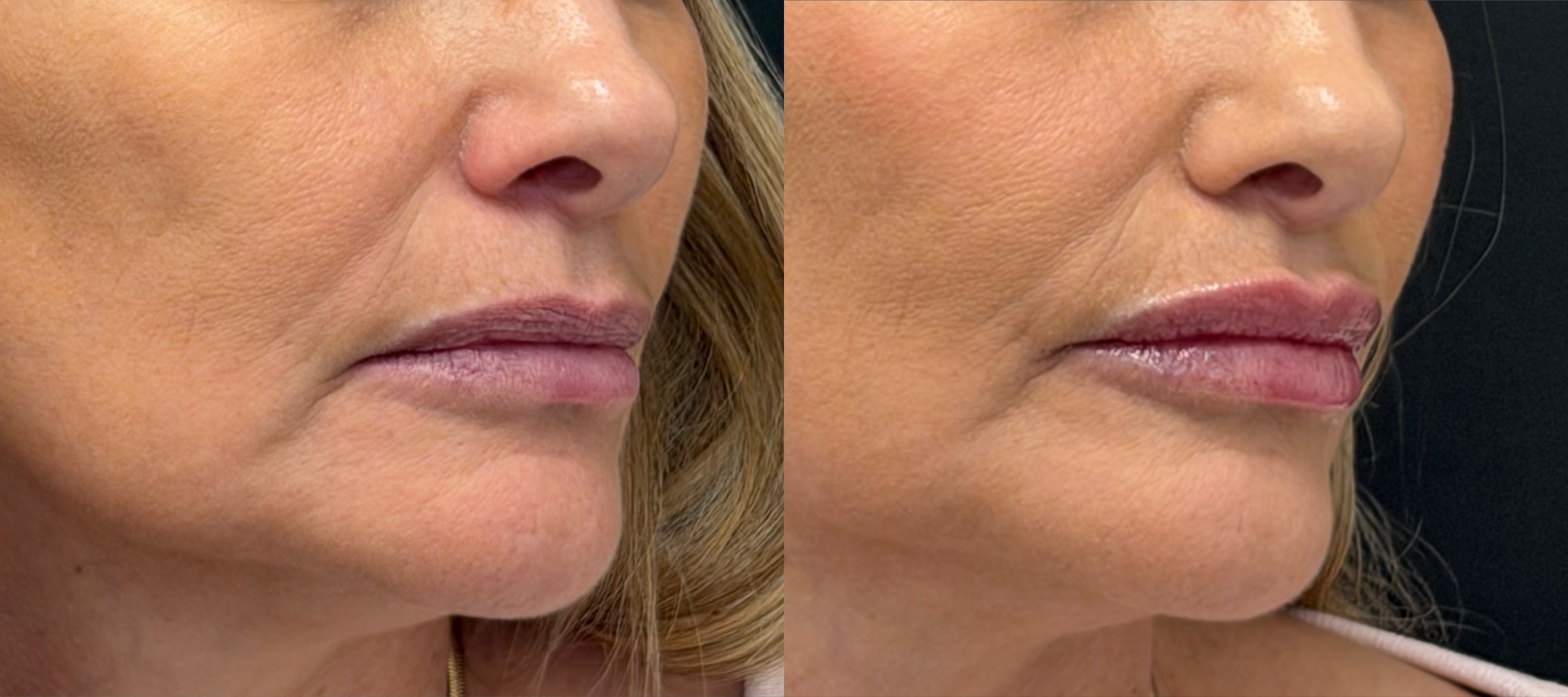 Lip enhancement before and after, three-quarter view