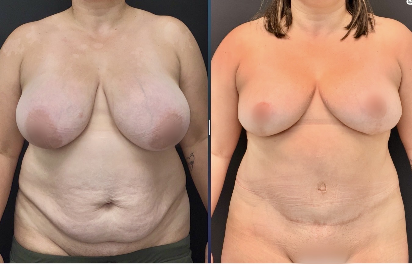 Mommy Makeover before and after