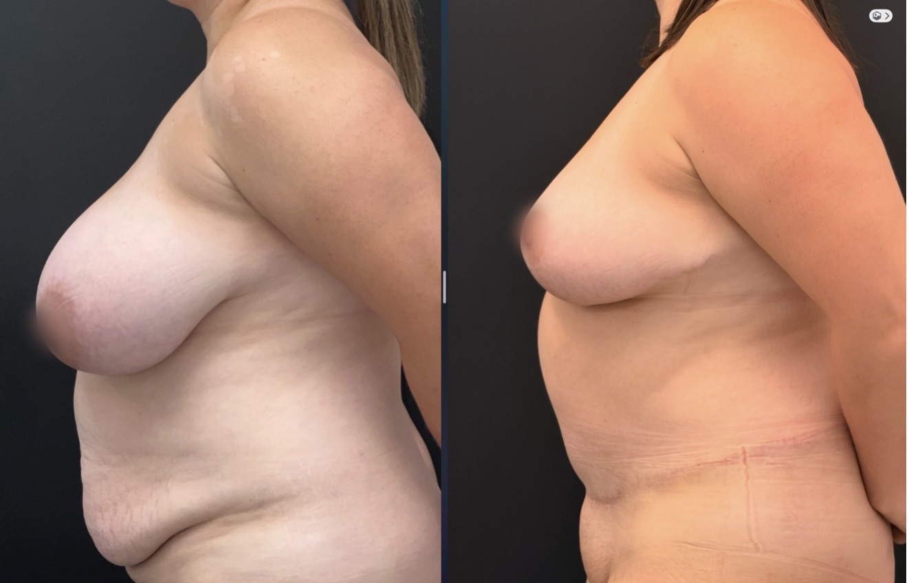 Mommy Makeover before and after