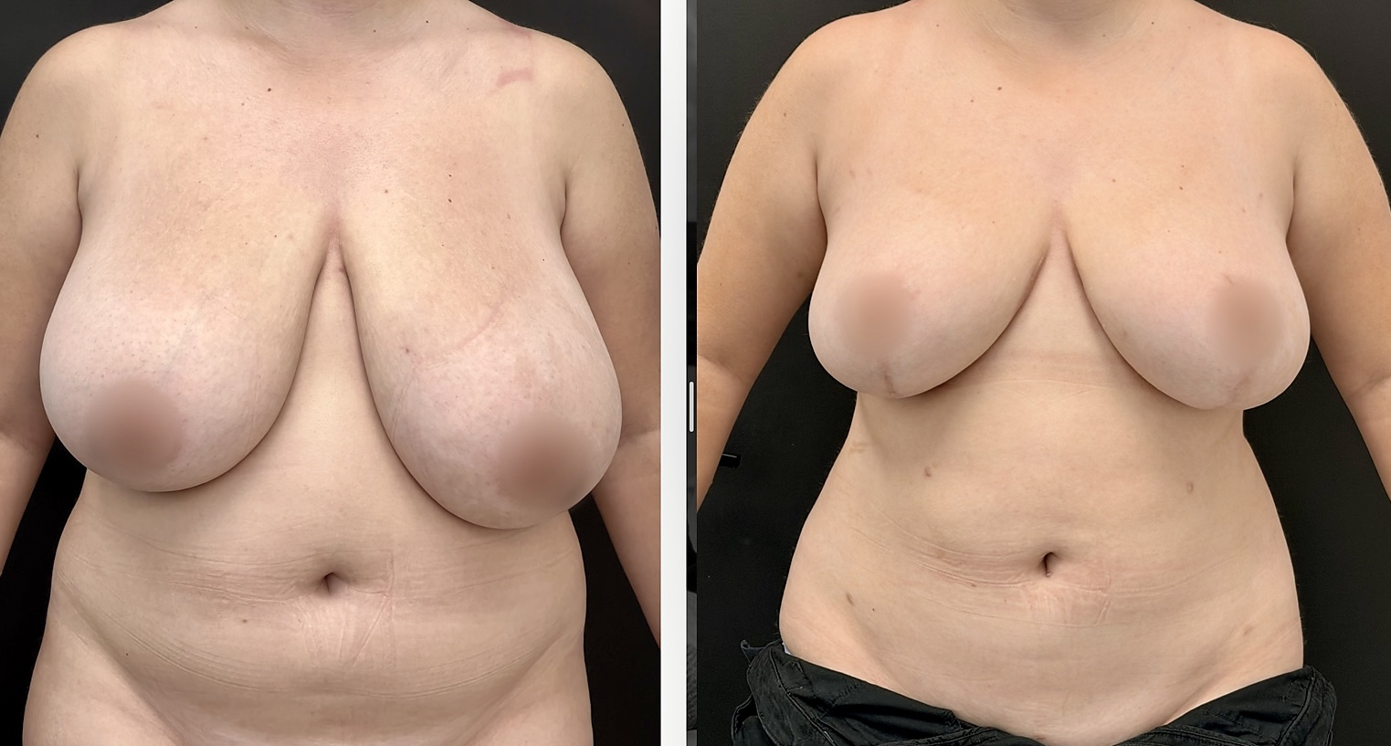 Mommy makeover before and after, front view