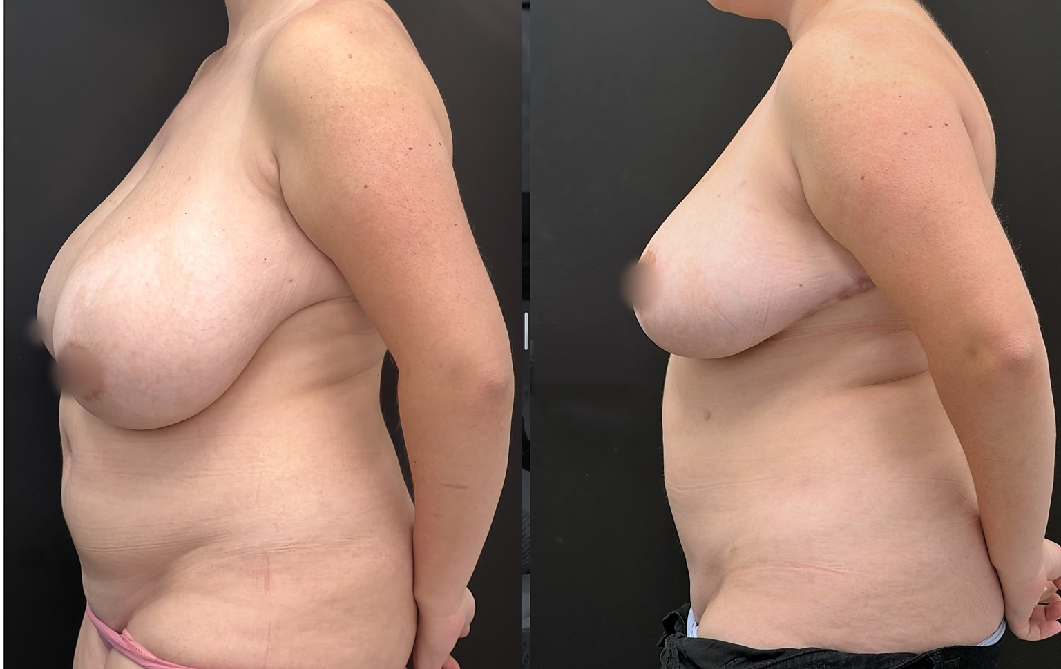 Mommy makeover before and after, side view