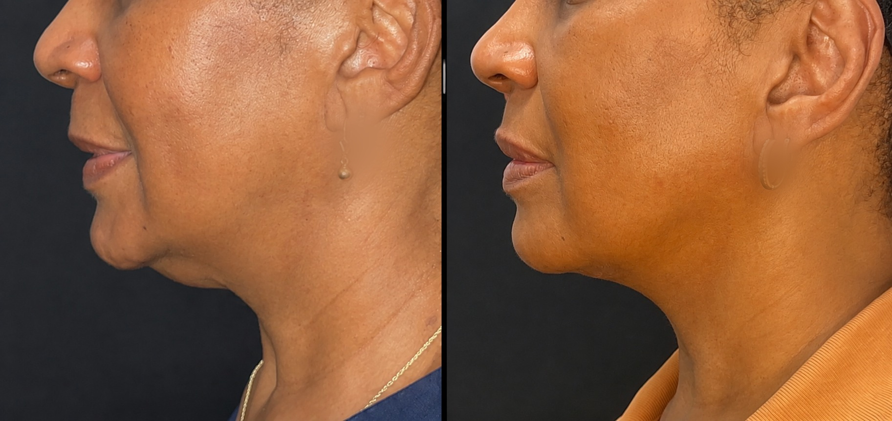 Neck Lift before and after