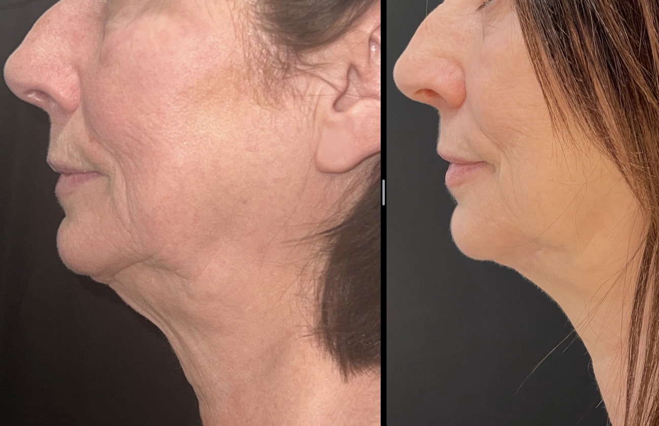 Neck Lift before and after
